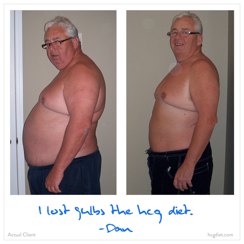 Dan lost 94 pounds on the hcg diet