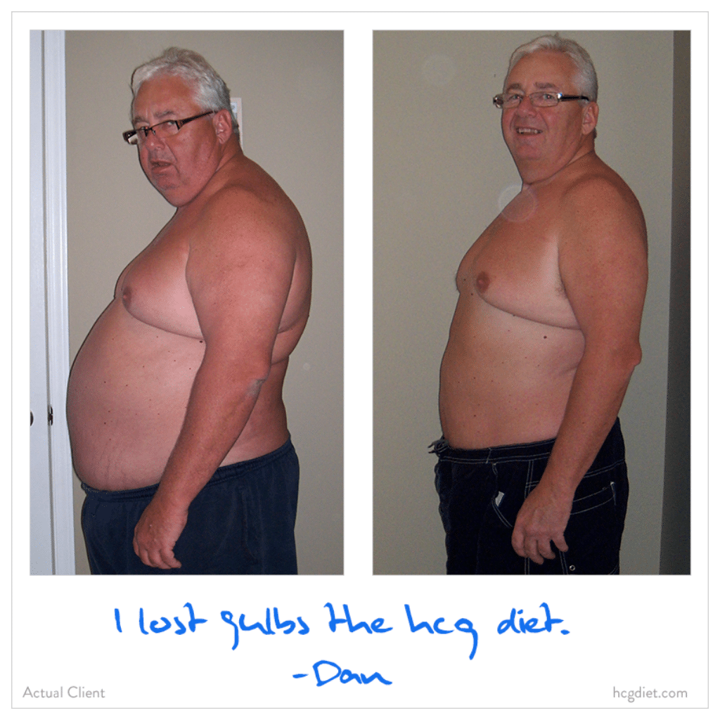 Dan lost 90 pounds on the hcg diet